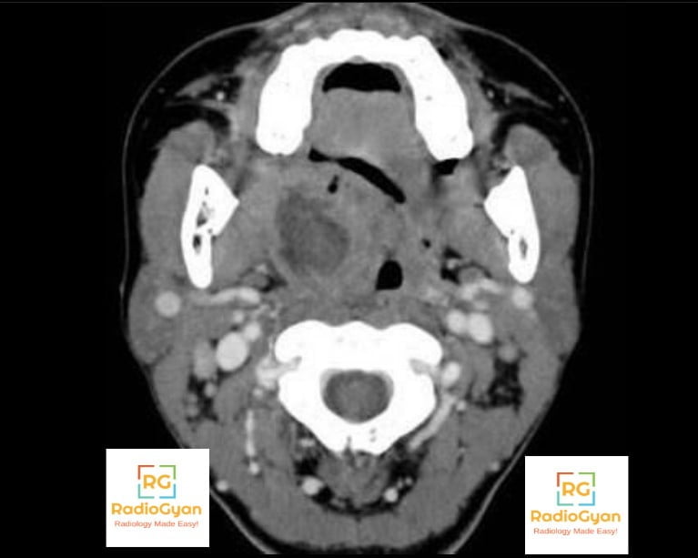 Right Tonsillar Abscess Radiology Case