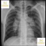 Sarcoidosis Chest Radiograph showing garland sign pawnbroker sign and 1-2-3 sign