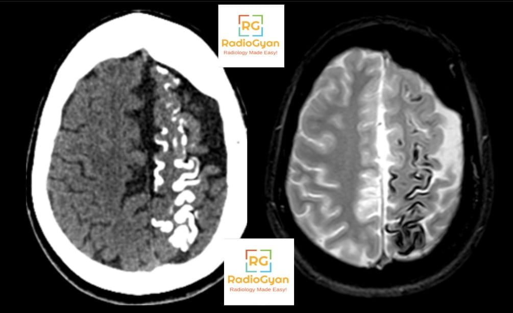 Axial unenhanced CT and axial gradient-echo MRI of Sturge-Weber syndrome showing gyriform tram-track cortical calcification and hemispheric atrophy