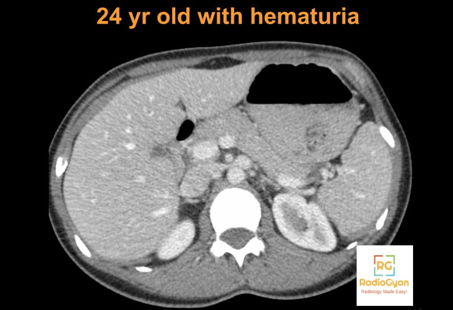Axial contrast-enhanced CT in a 24-year-old with haematuria showing compression of the left renal vein between the aorta and superior mesenteric artery, anterior nutcracker syndrome