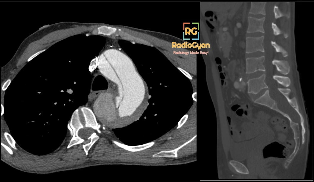 CT showing ascending aortic dilatation with dissection and lumbar dural ectasia in Marfan syndrome