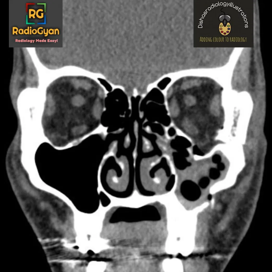 Coronal CT image through the orbits demonstrates a fracture of the inferior wall of the left orbit with associated herniation of orbital fat into the maxillary sinus. There is also evidence of left maxillary sinus opacification.