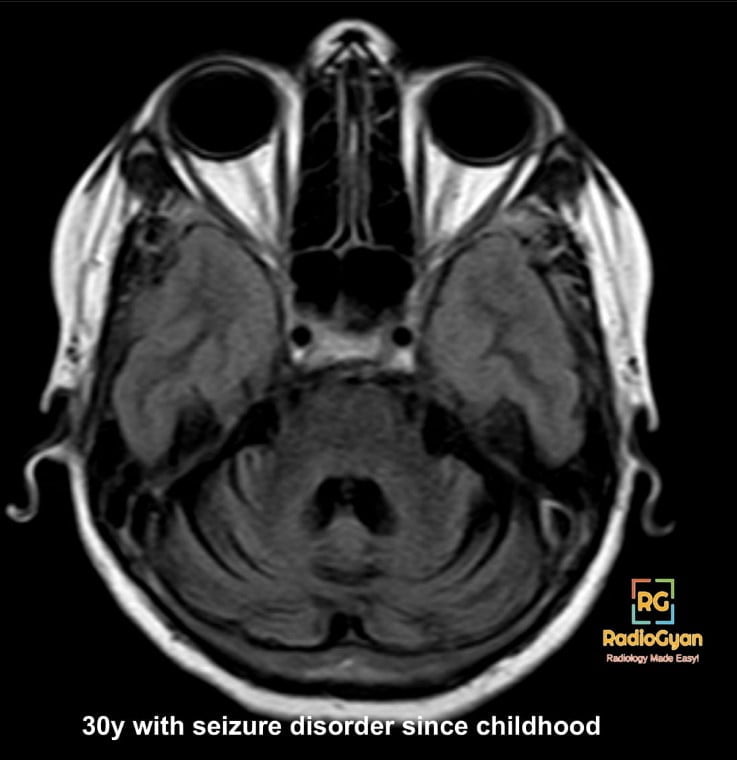 Cerebellar Atrophy Secondary To Phenytoin Radiology Case