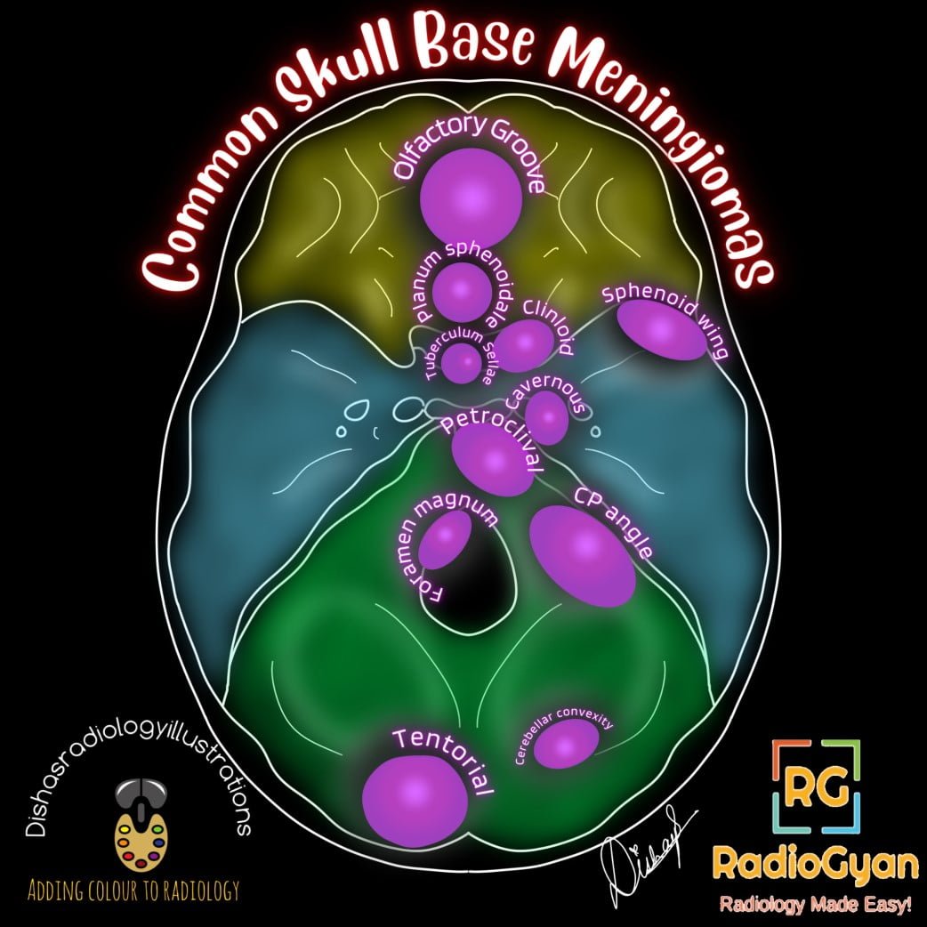 健康・医学 Meningiomas, Part II (Volume 170) i2 Meningioma | Radiology Case |