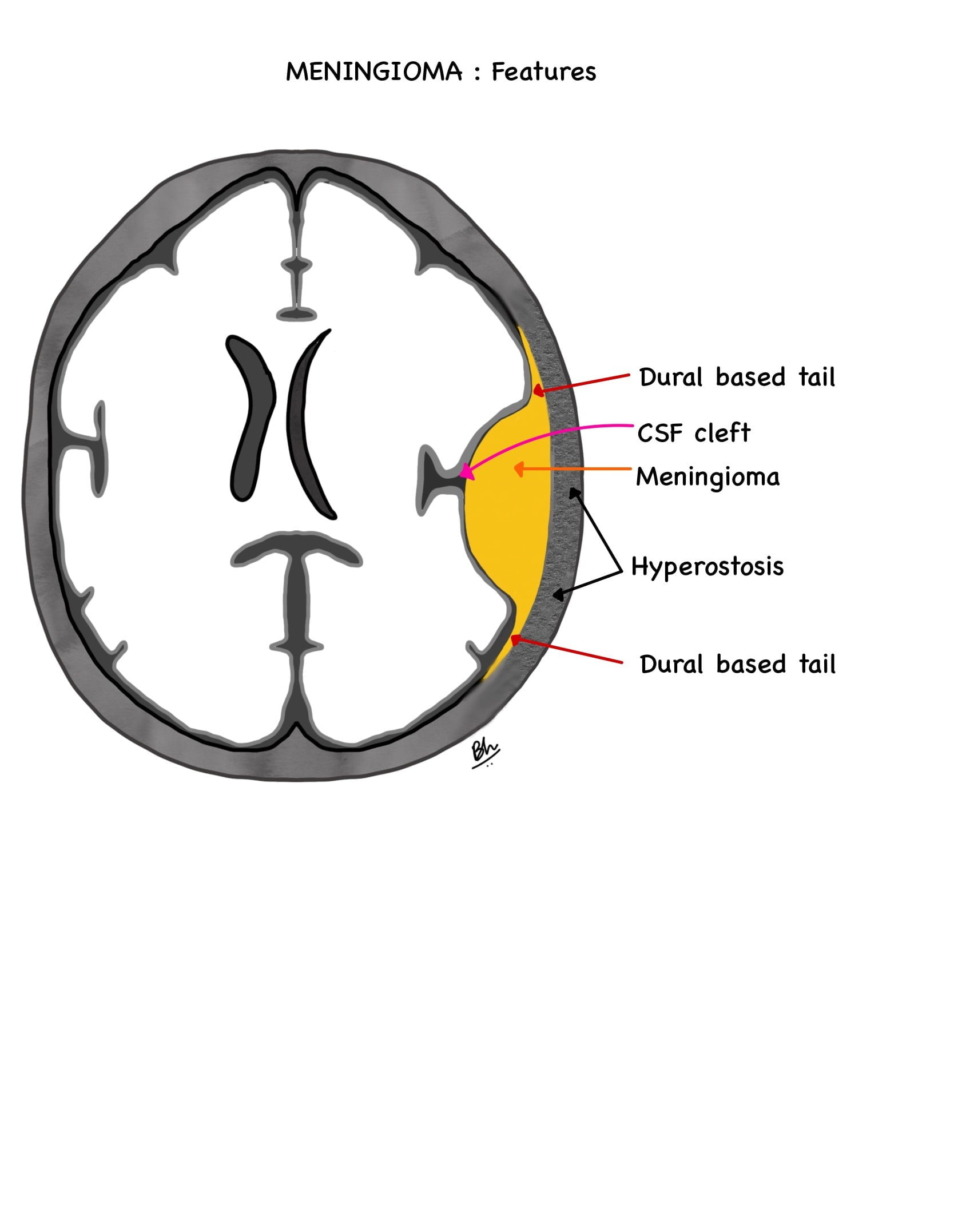 Diagram of an axial brain showing the key features of a convexity meningioma: dural tail, CSF cleft and hyperostosis