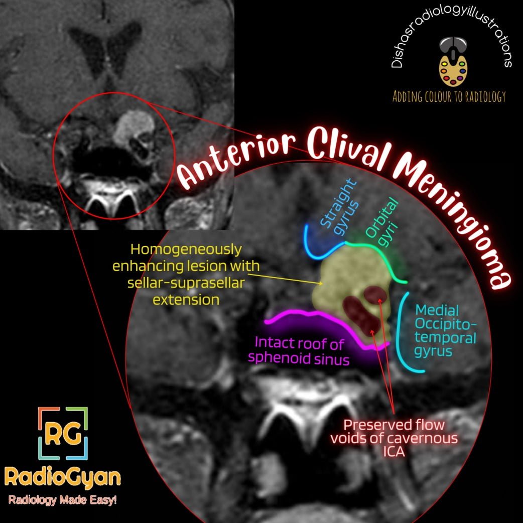 健康・医学 Meningiomas, Part II (Volume 170) i2 Meningioma Radiomics: At the Nexus of Imaging, Pathology and