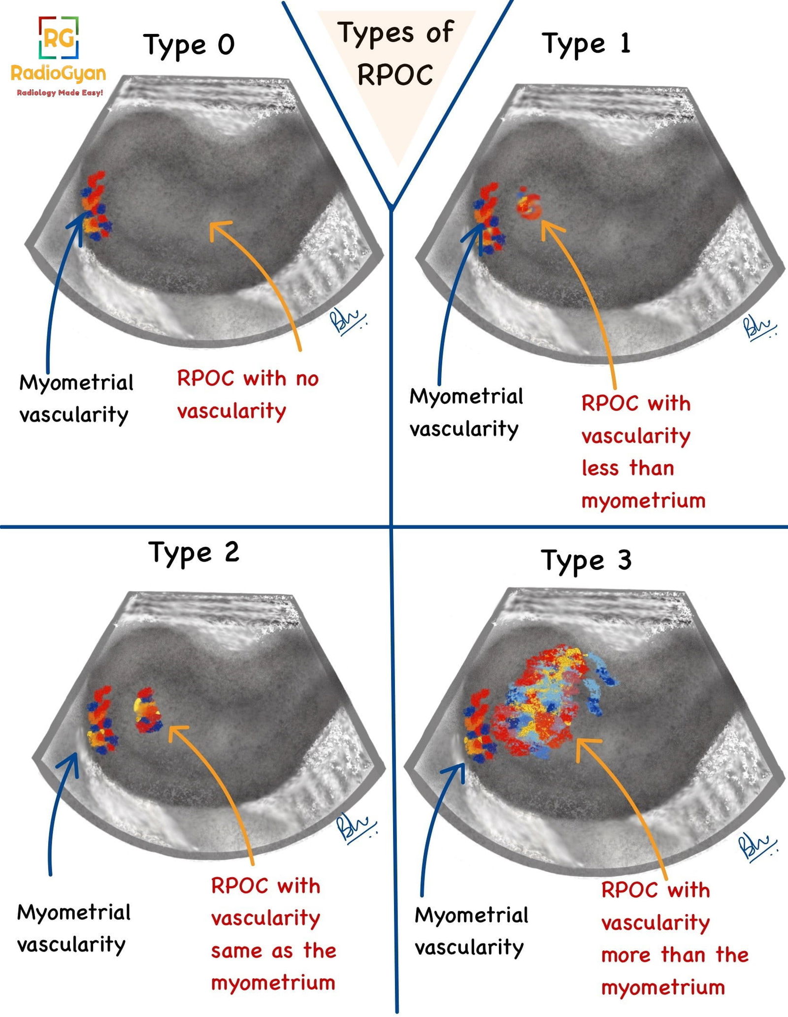 Illustration showing the types of Retained products of Conception