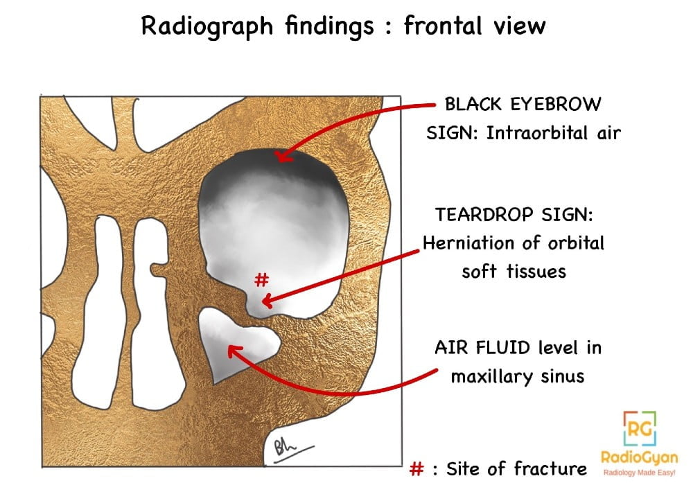 Infraorbital blowout fracture illustration.