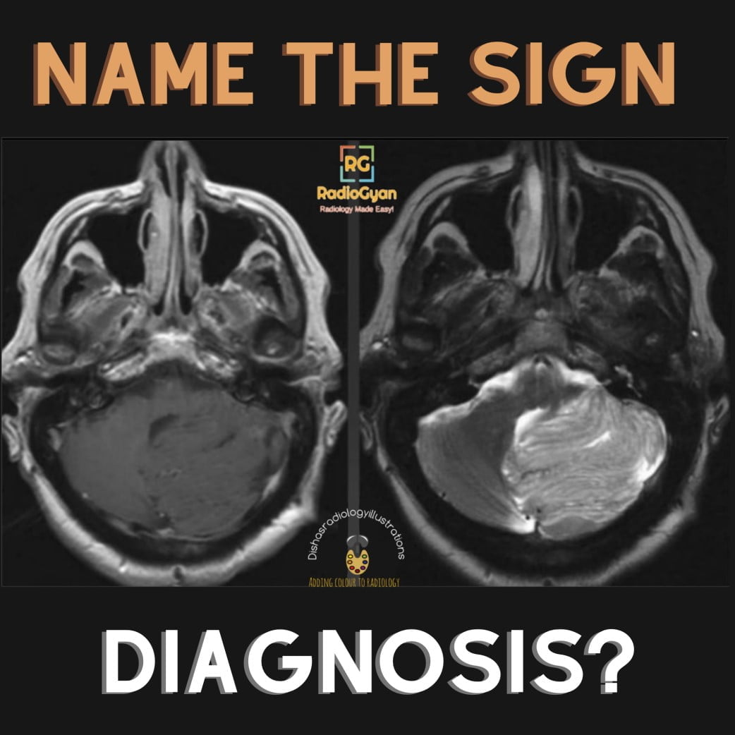 Lhermitte Duclos Disease Radiology Case