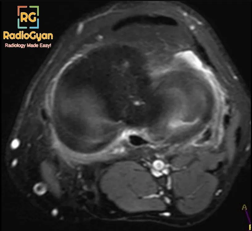 Parrot Beak Meniscus Tear Radiology Case