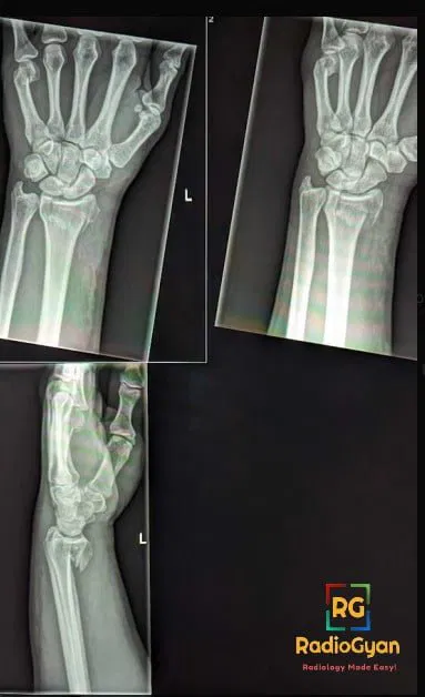 AP and lateral radiographs of the left distal radius and ulna demonstrating dorsal angulation seen in Smith Fracture