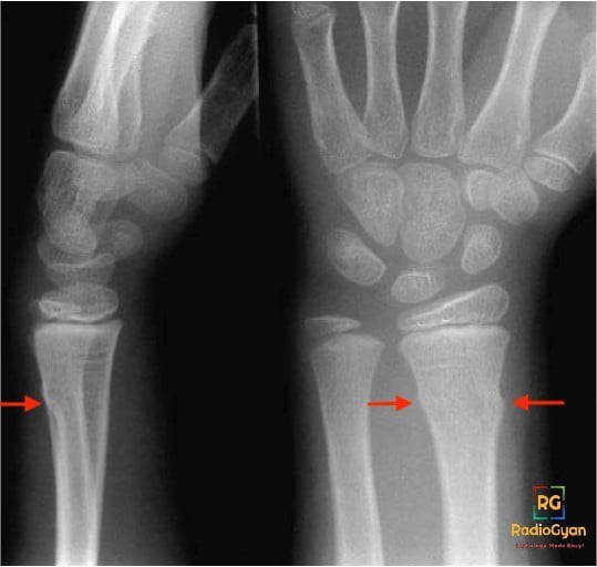 Torus Fracture Radiology Case