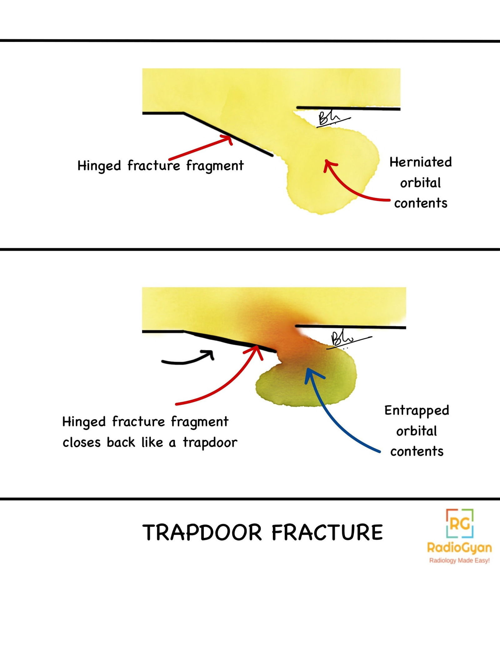 Trapdoor orbital fractures illustration