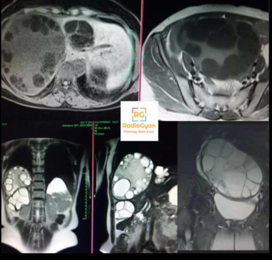 Axial T1 and coronal T2 MRI of hepatic and pelvic hydatid disease showing a multivesicular liver cyst packed with daughter cysts and a large multiseptated pelvic cyst