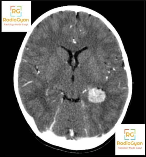 Axial contrast-enhanced CT showing an avidly enhancing well-defined mass in the atrium of the left lateral ventricle