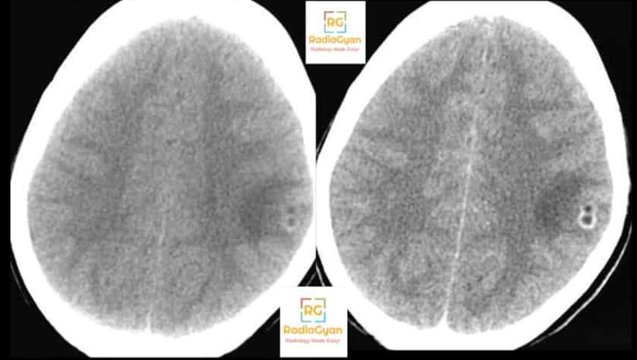 Unenhanced and contrast-enhanced CT brain showing a small left parietal ring-enhancing neurocysticercosis lesion with an eccentric scolex