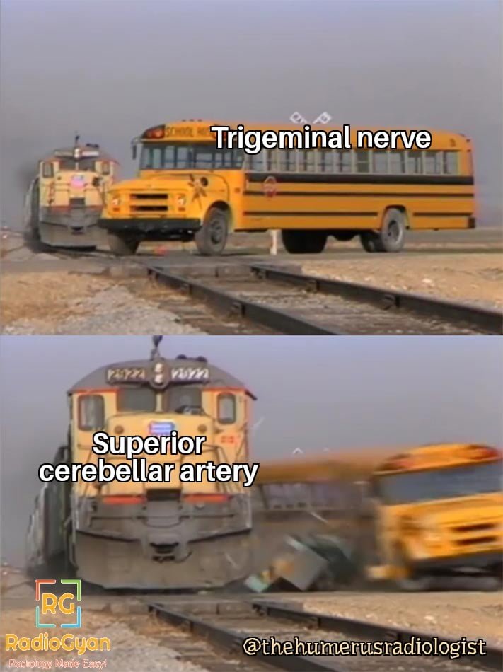Two-panel illustration using a train colliding with a school bus as an analogy for the superior cerebellar artery compressing the trigeminal nerve