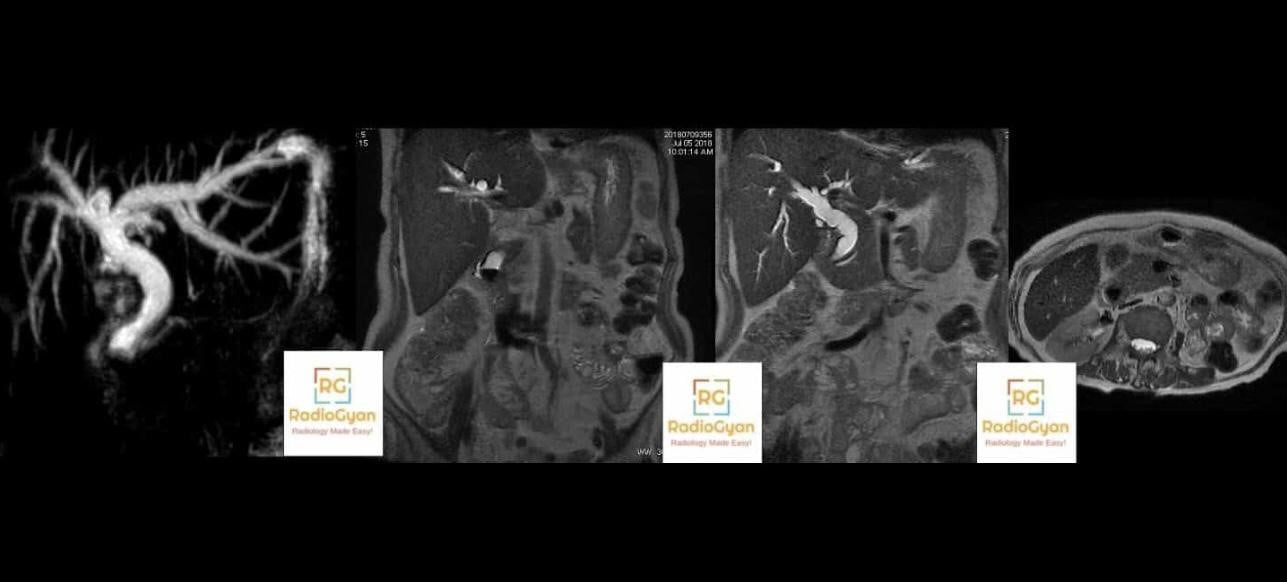 MRCP and MRI showing biliary duct dilatation secondary to choledocholithiasis