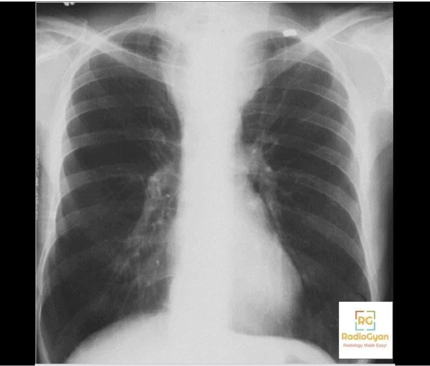 Enlarged Thyroid Gland Radiology Case