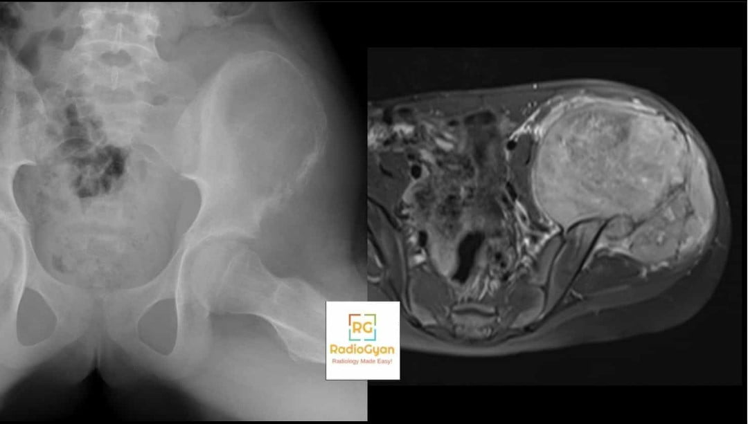 Pelvic radiograph and axial MRI showing Ewing sarcoma of the ilium with permeative bone destruction and a large soft-tissue mass