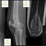 Osteogenic Sarcoma Distal Femur With Codman’s Triangle Radiology Case