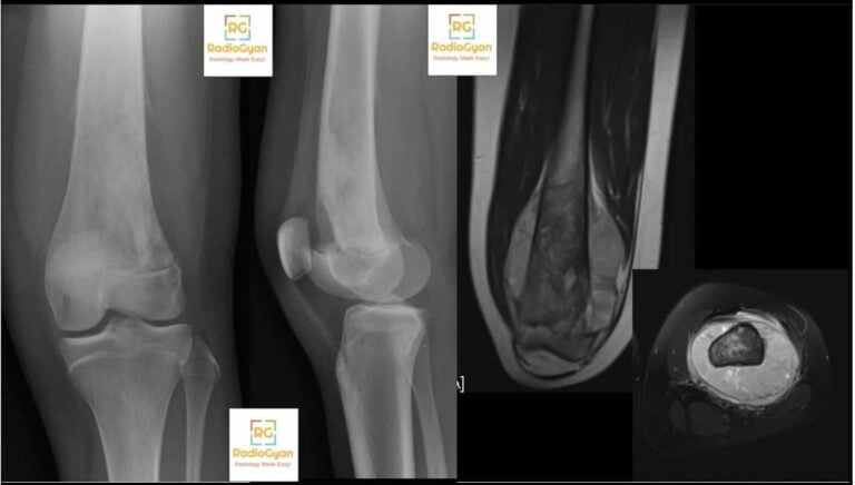 Codman's triangle | Radiology Signs