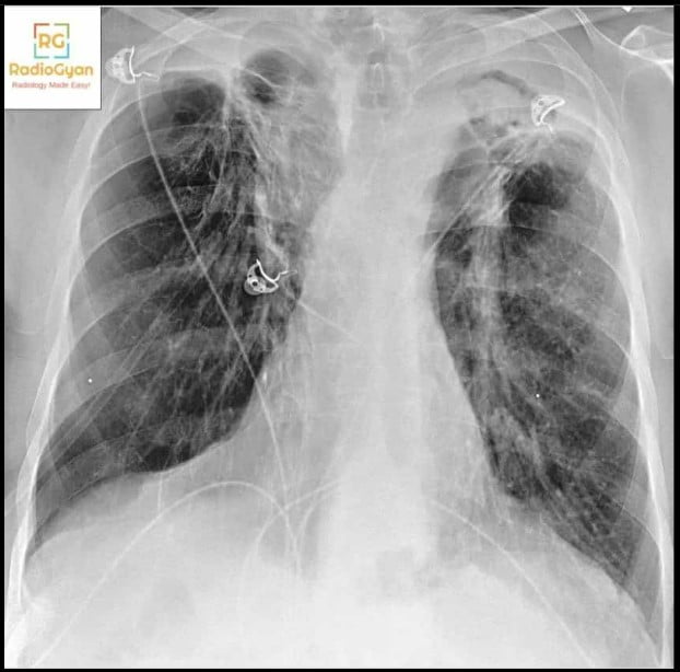 Chest radiograph showing left upper zone fibrosis and volume loss after tuberculosis with a mycetoma in the residual cavity