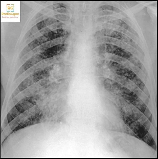 Chest radiograph in silicosis showing bilateral upper and mid zone nodular opacities coalescing into masses