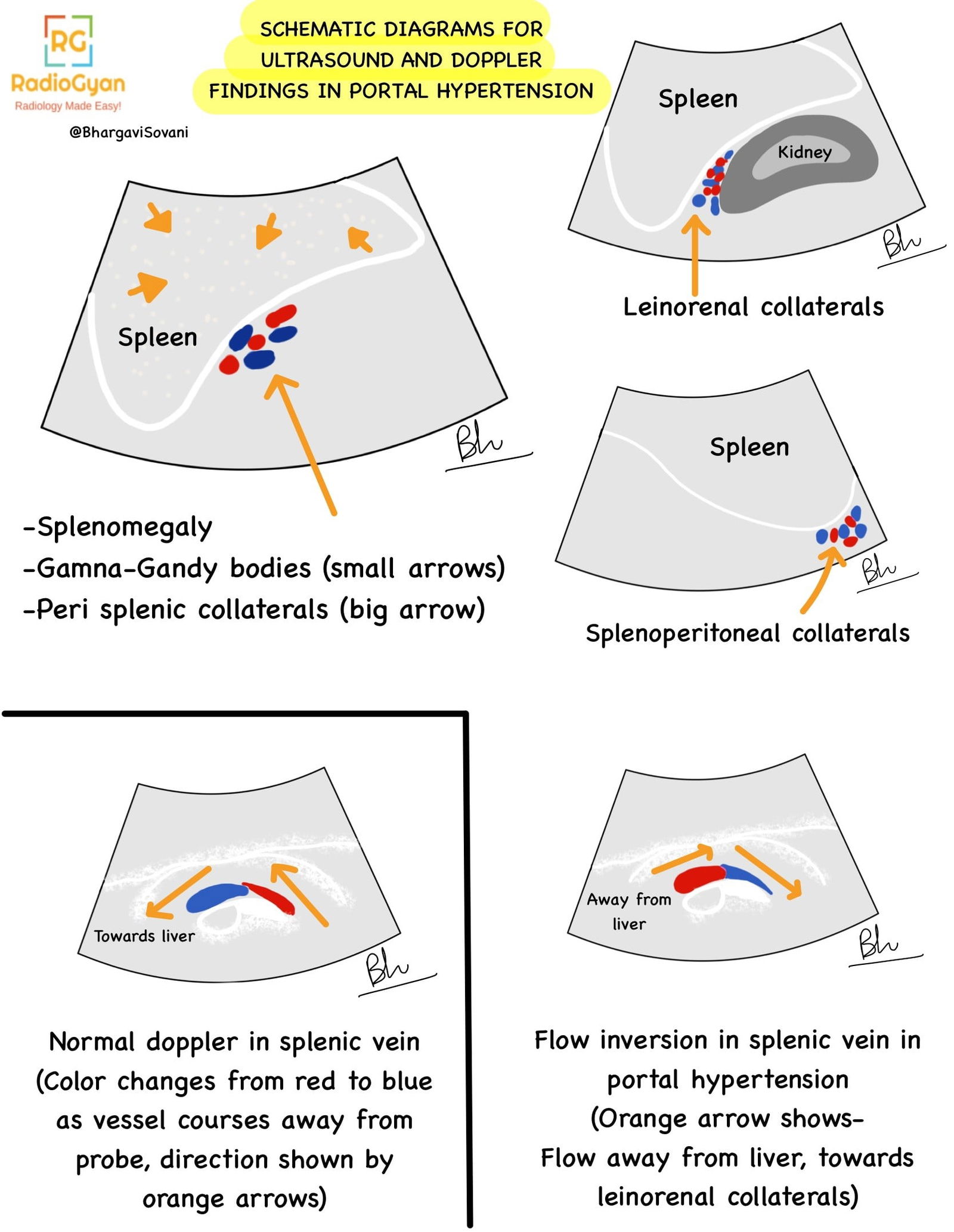 Line diagrams illustrating ultrasound and Doppler findings in portal hypertension, showing changes in blood flow patterns and vessel structure.