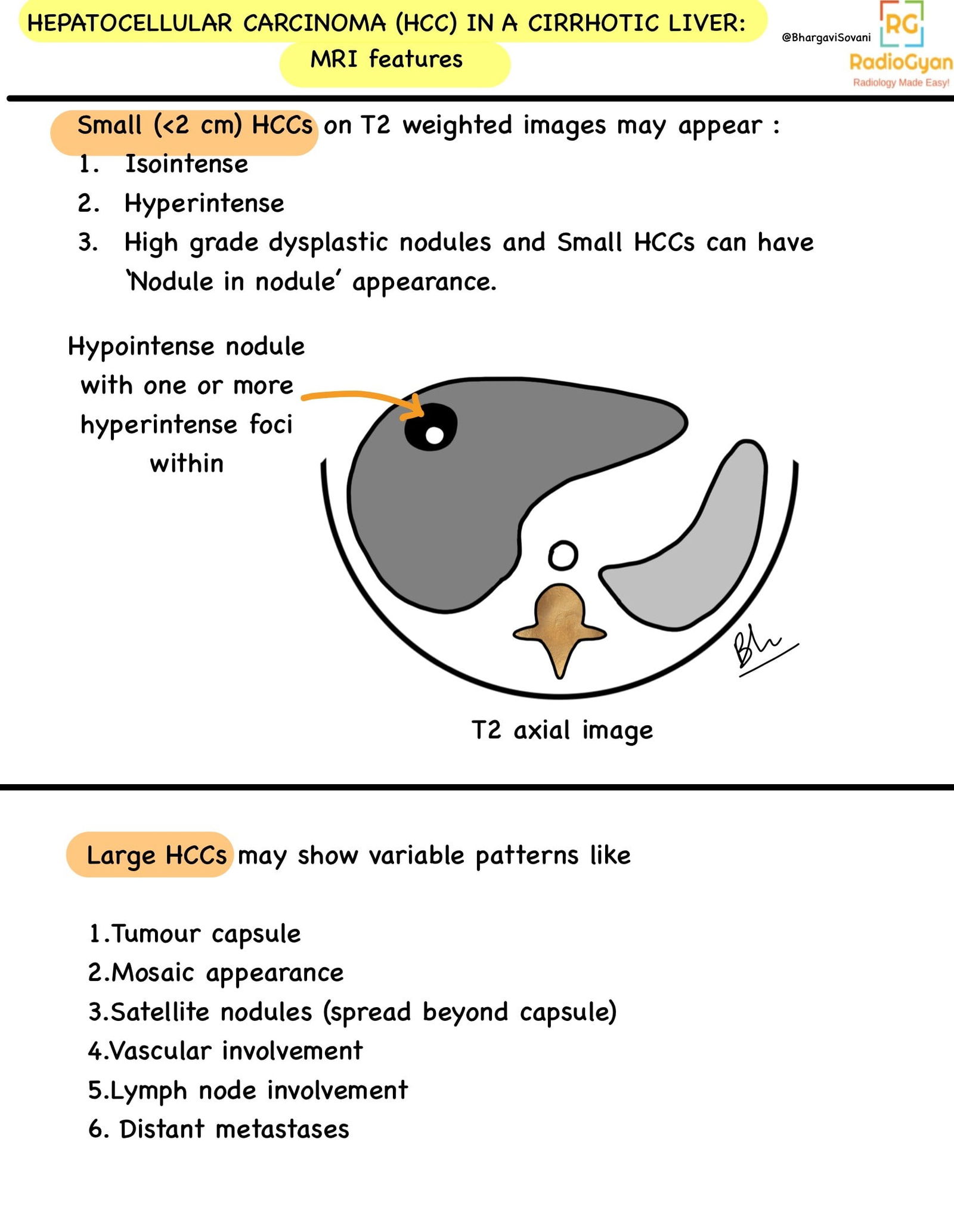 Simple line diagram illustrating the 'nodule in nodule' appearance characteristic of hepatocellular carcinoma in cirrhotic livers, as depicted on MRI. The diagram provides a summary of key features aiding in the recognition and diagnosis of hepatocellular carcinoma within the context of cirrhosis.