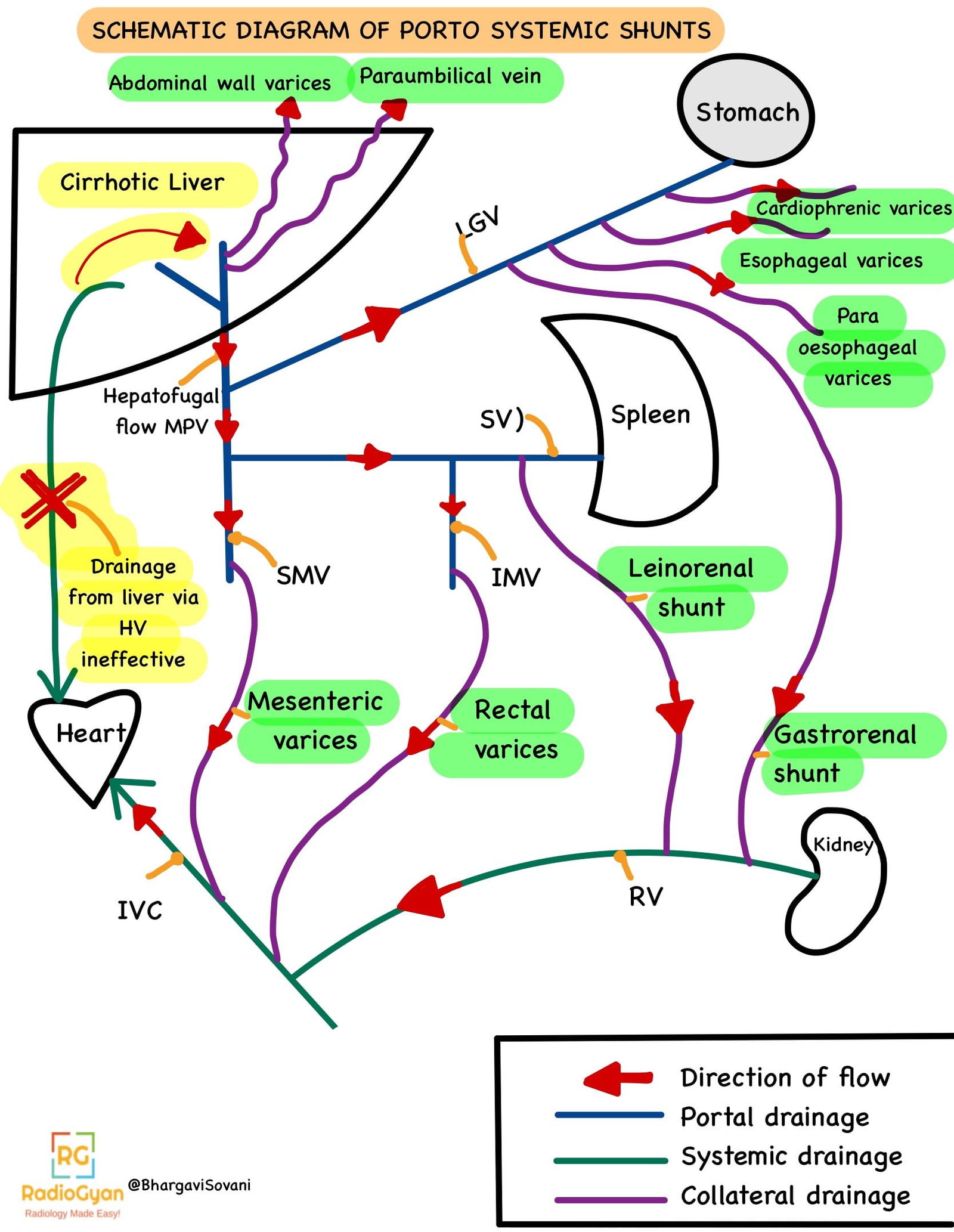 A simple line diagram illustrating the altered direction of portal and systemic flow in the case of cirrhosis. The diagram visually depicts the abnormal blood circulation patterns that occur in cirrhotic livers, highlighting the changes in flow direction within the portal system.