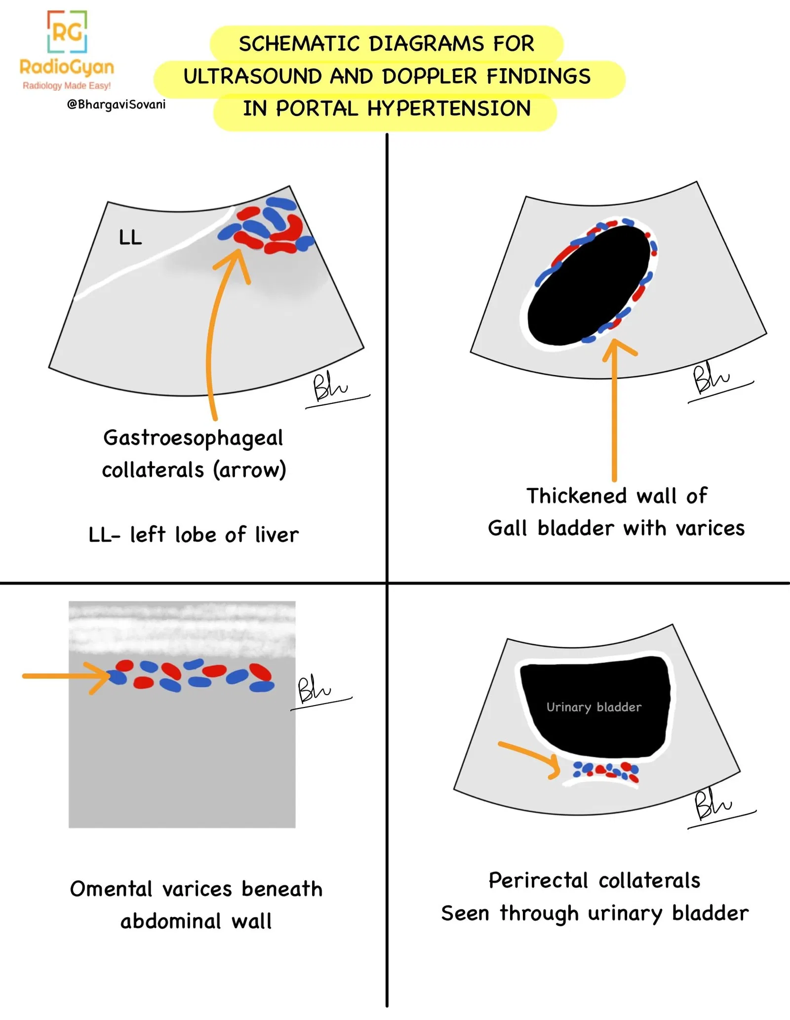 Schematic line diagrams of ultrasound and Doppler findings in portal hypertension, highlighting altered blood flow and vessel structure.