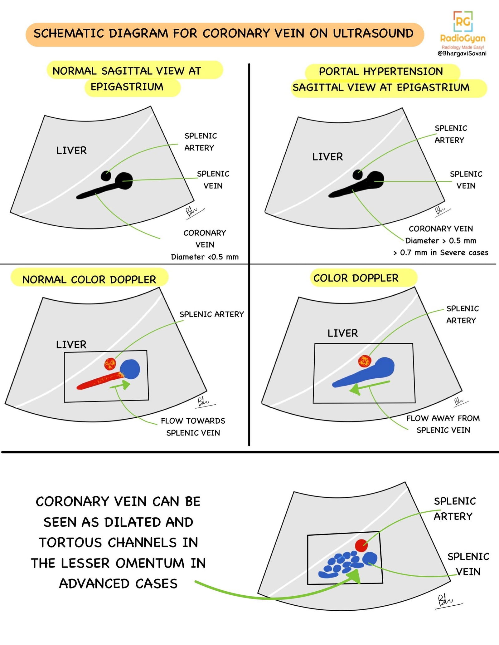 Schematic diagrams of Doppler ultrasound findings of the coronary vein, comparing normal conditions with portal hypertension, using simple line drawings to show blood flow differences.