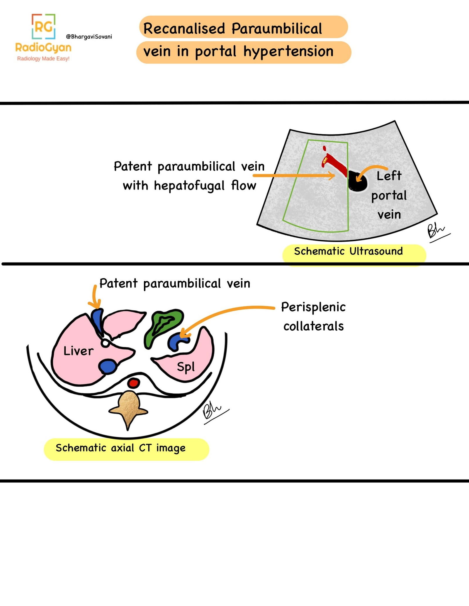Schematic diagrams showing ultrasound, Doppler, and axial CT/MRI findings of the paraumbilical vein in portal hypertension. The illustrations use simple line drawings to depict the abnormal blood flow and structural changes associated with portal hypertension.