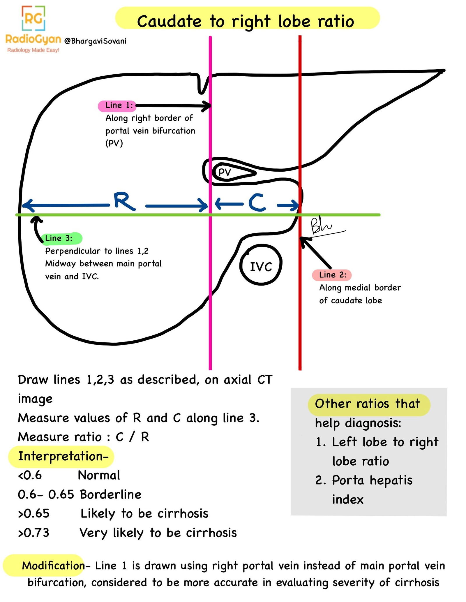 A summary providing a simple explanation of the calculation and interpretation of the caudate to right lobe ratio. The summary outlines the steps to measure the ratio and its significance in medical diagnostics, particularly in assessing liver conditions.