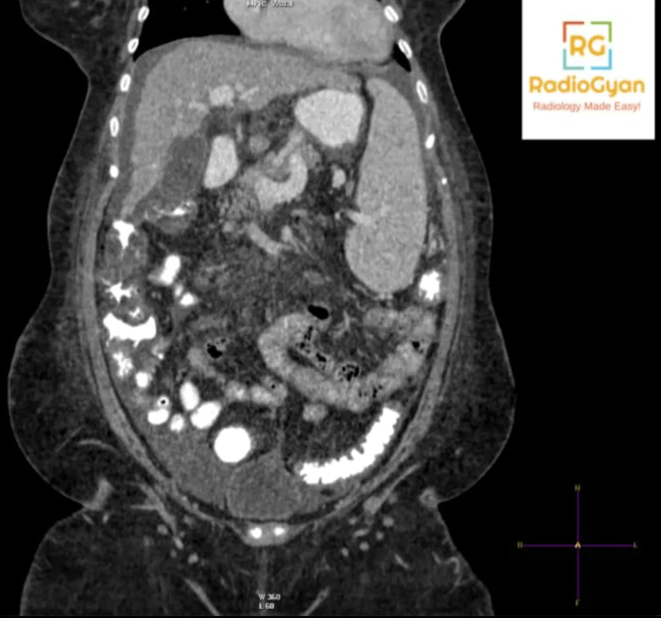 Coronal contrast-enhanced CT abdomen demonstrating ascites, splenomegaly, and hepatomegaly.
