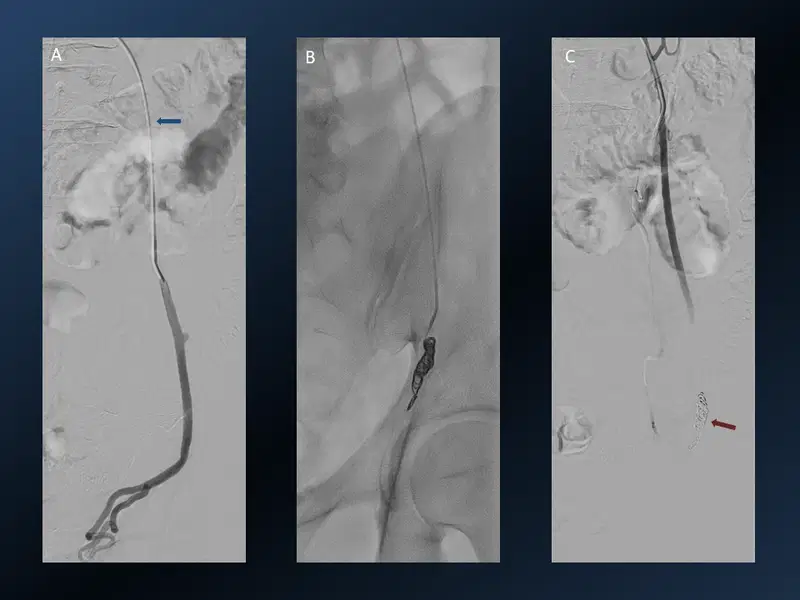 Varicoele Embolisation Interventional Radiology