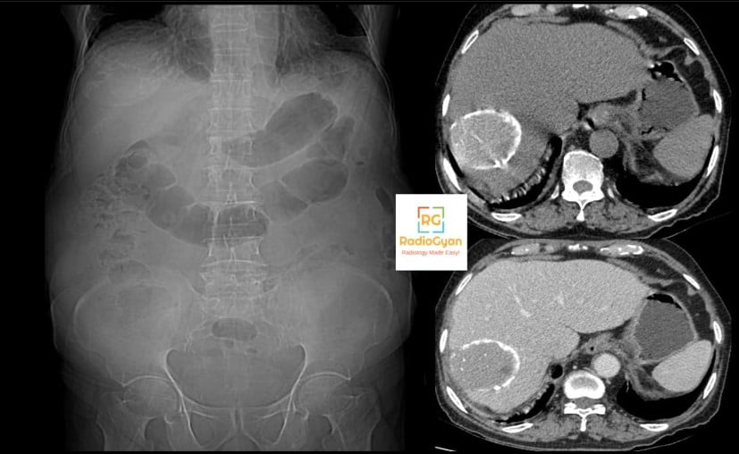 Scout radiograph and axial CT of a hepatic hydatid cyst in the right lobe with a thick peripheral calcified rim and heterogeneous internal content
