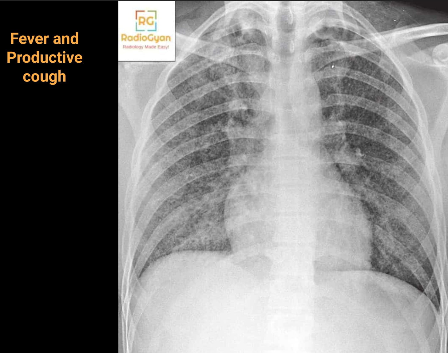 Frontal chest radiograph in miliary tuberculosis showing innumerable uniform 1 to 2 mm nodules evenly distributed through both lungs