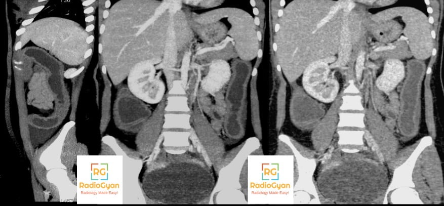 Ulcerative Colitis- Lead Pipe Colon Radiology Case