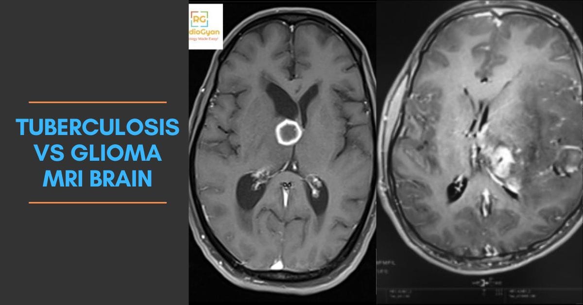Tuberculosis vs Glioma MRI brain