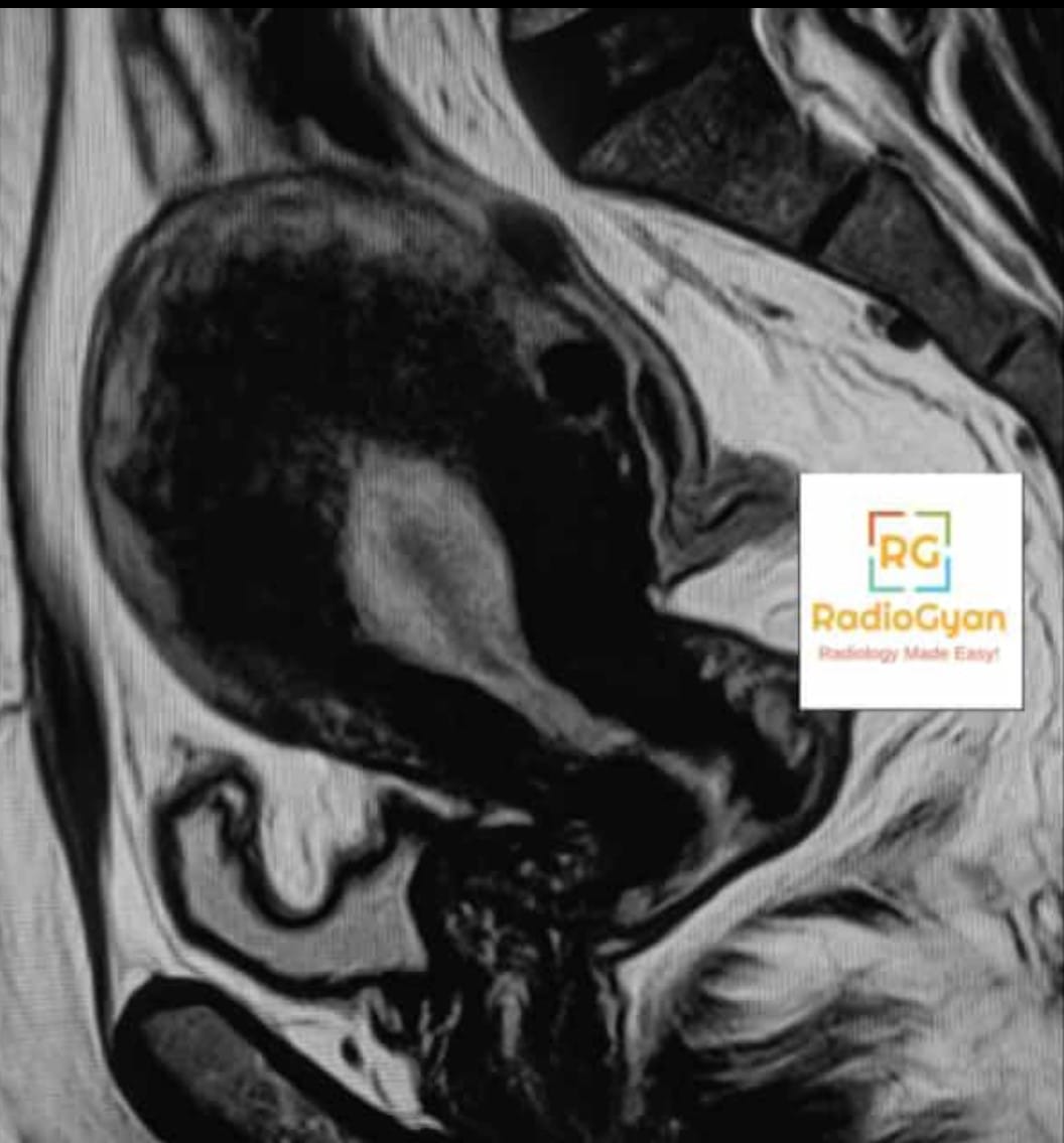 Sagittal T2 weighted MRI showing a markedly thickened low signal junctional zone in adenomyosis