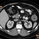CT showing an intussusception in the left upper quadrant of the abdomen