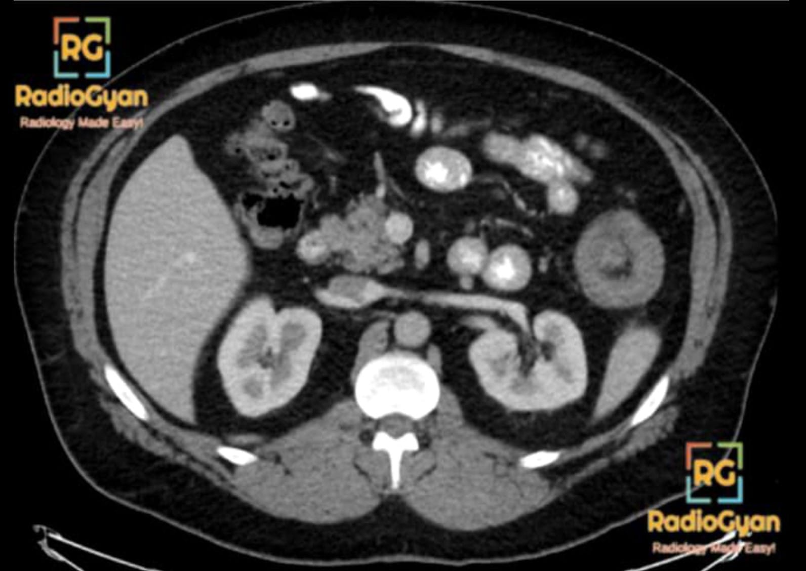 CT showing an intussusception in the left upper quadrant of the abdomen