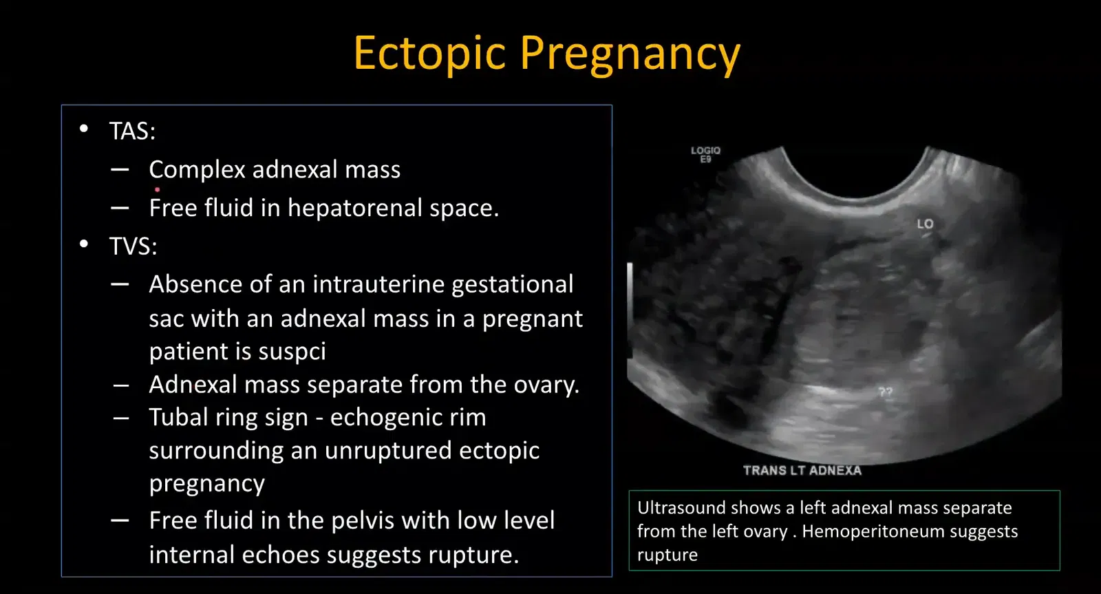 Adnexal mass separate from ovary on transvaginal ultrasound suggestive of ectopic pregnancy