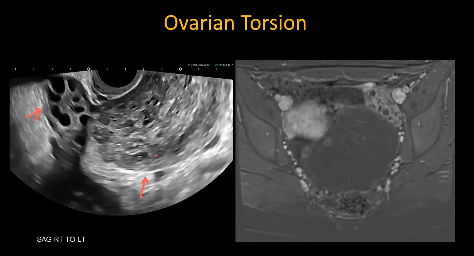 Ultrasound showing enlarged ovary. MRI post-contrast image showing non-enhancing twisted ovary in torsion