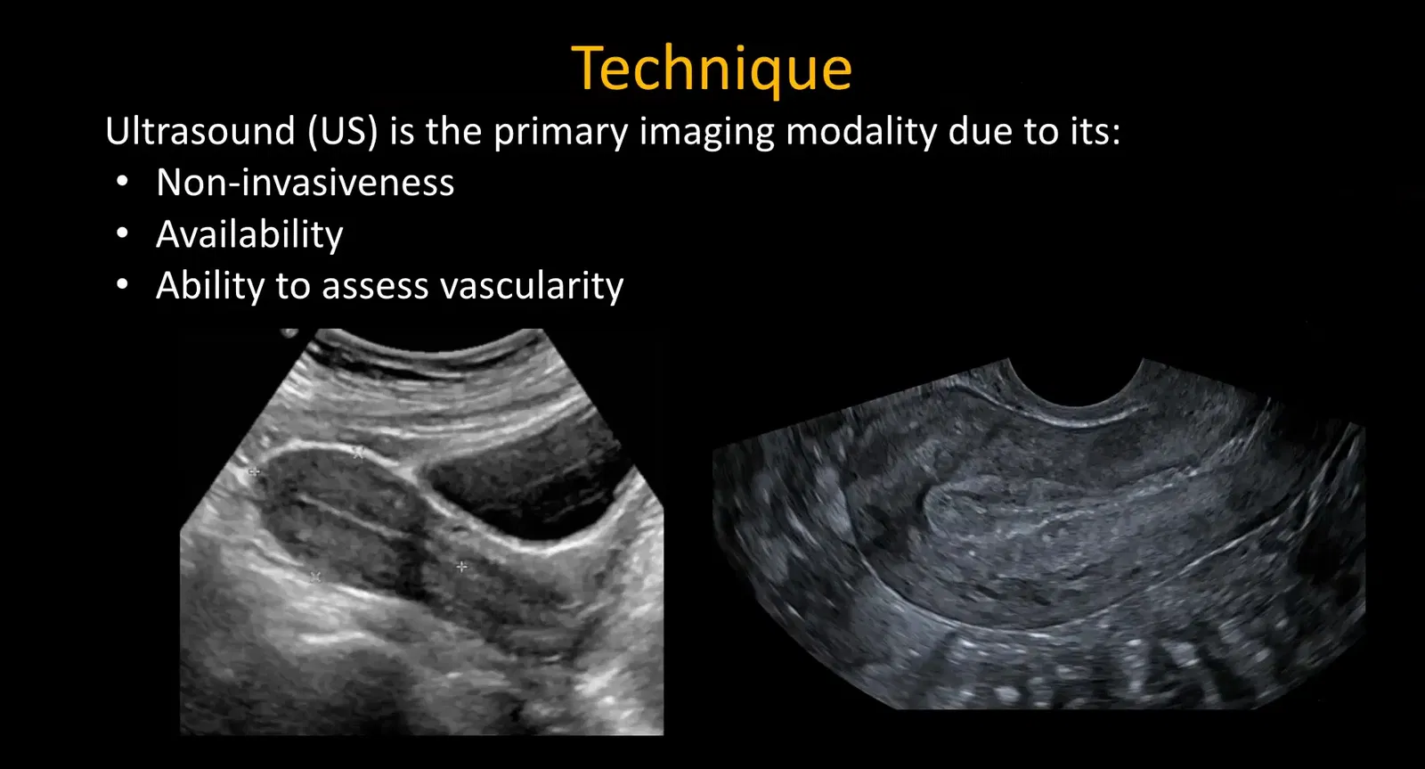 Transabdominal pelvic ultrasound with a full bladder as an acoustic window, demonstrating techniques for ultrasound evaluation of pelvic emergencies.