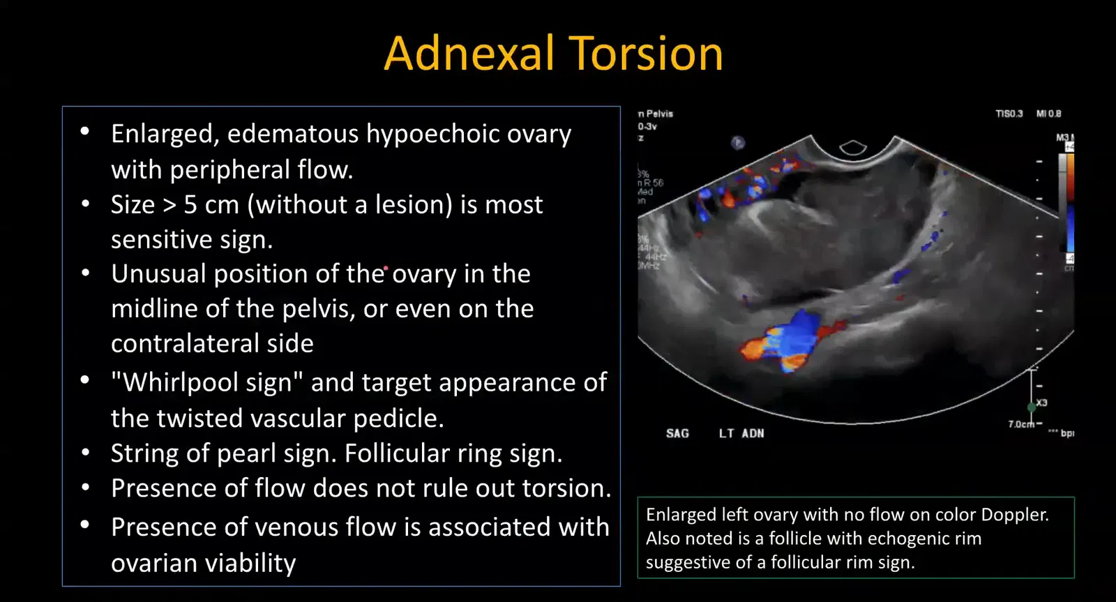 Enlarged ovary with absent Doppler flow in adnexal torsion
