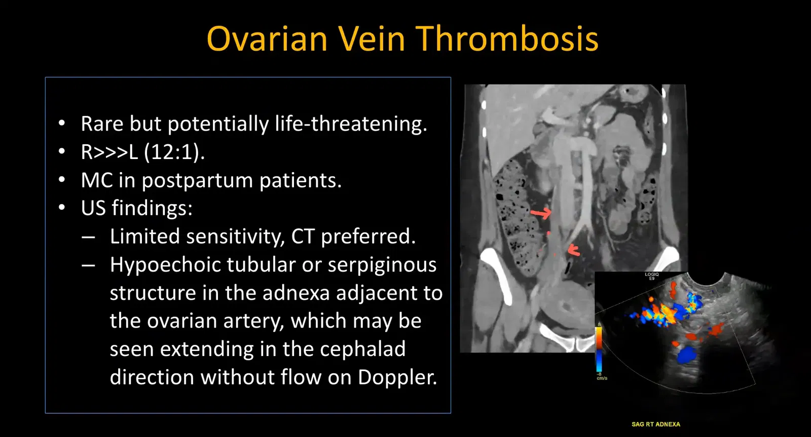 CT showing dilated right ovarian vein with filling defect indicating thrombosis