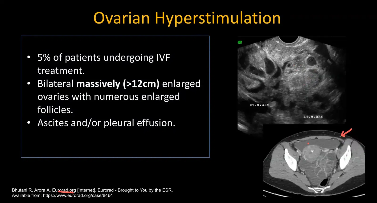 CT image showing massively enlarged ovary and free fluid in ovarian hyperstimulation syndrome